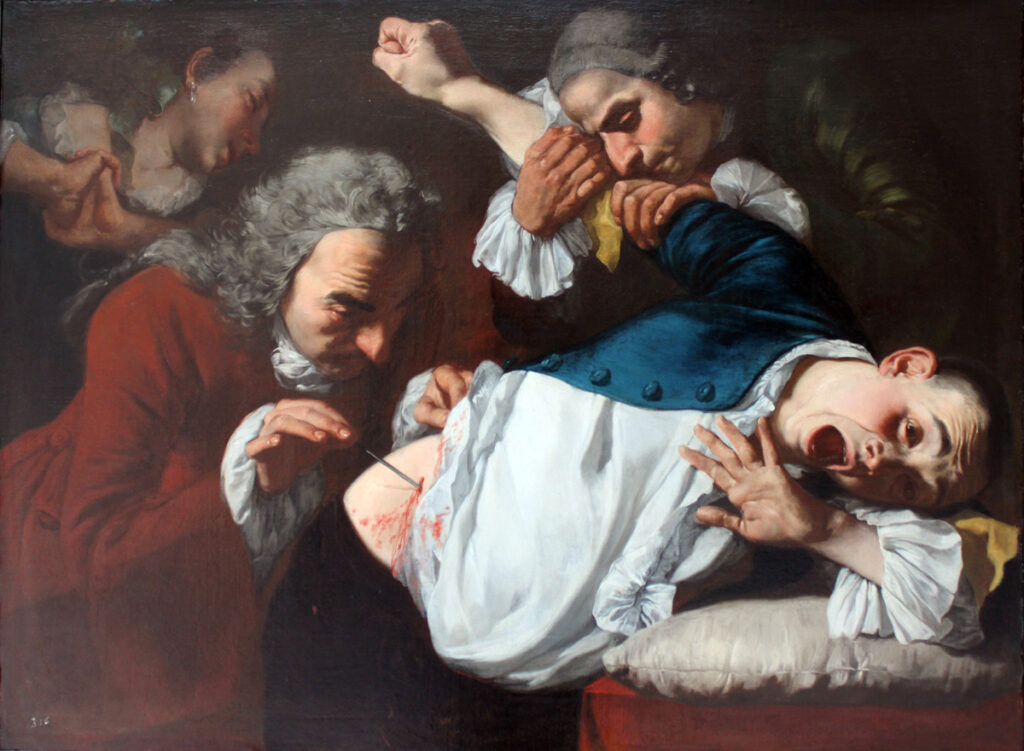 Surgical operation. Gaspare Traversi 1753